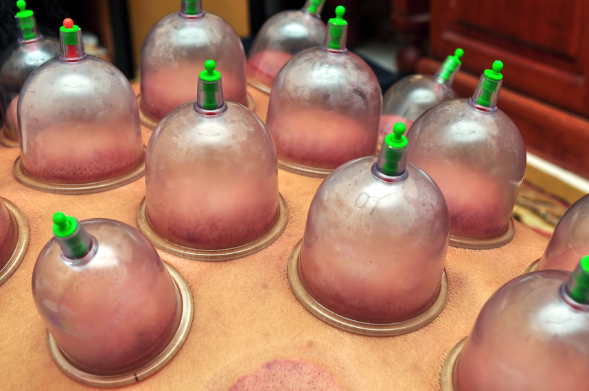 Cupping or Bekam Hijamah is traditional treatment