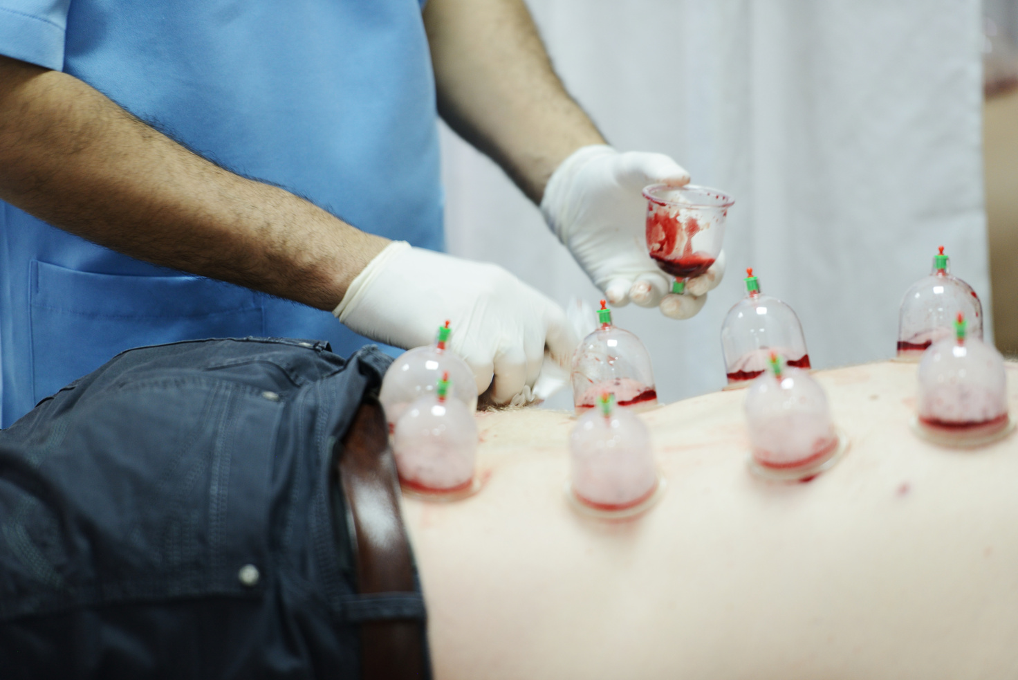 Medical Hijama Cupping Therapy 
